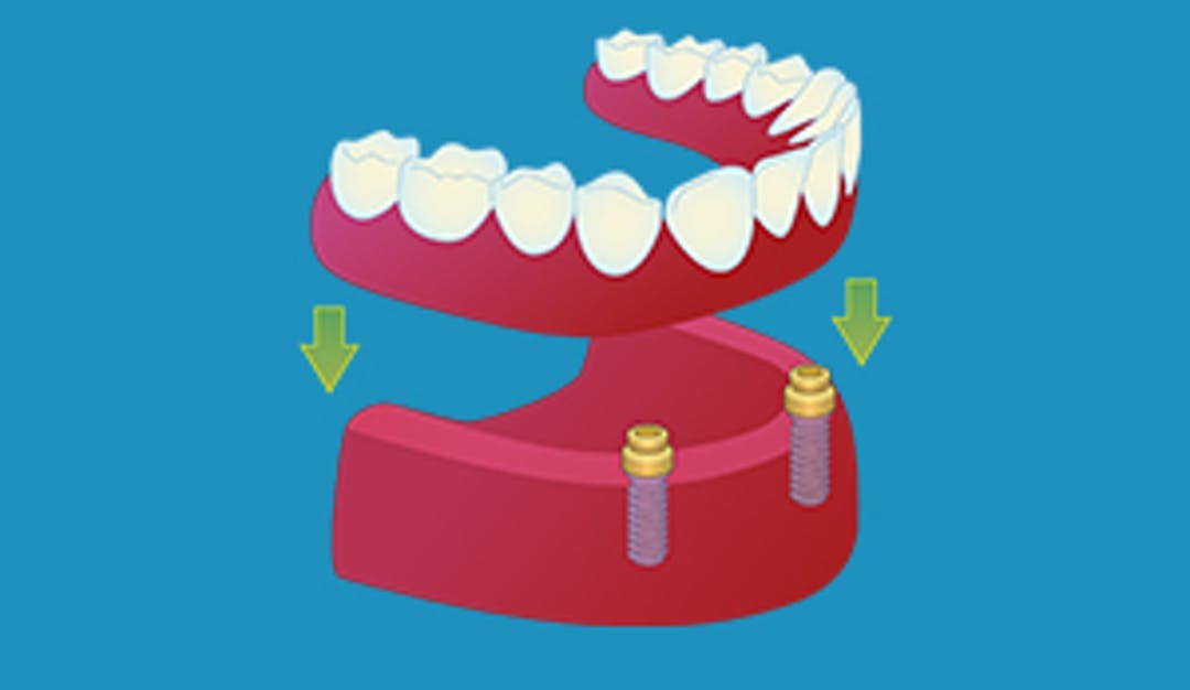 Implantat_locator_thumbnail_w300__6e2bd461288d1163a1adb624718c669e